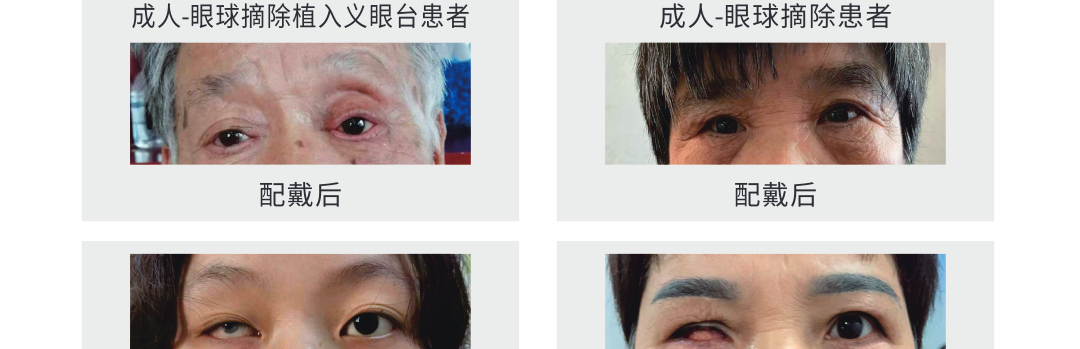 眼球摘除定做義眼